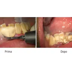 Prima e dopo la rimozione del tartaro denti. I denti sono visibilmente più puliti dopo il trattamento.