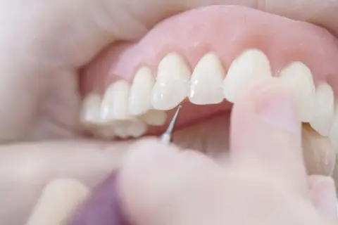 Dettaglio di una dentiera che viene posizionata, un passo importante per abituarsi alla dentiera e ritrovare un sorriso smagliante.
