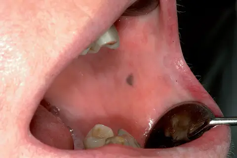 Una macchia scura sul palato, visibile vicino ai denti e a uno specchietto dentale.