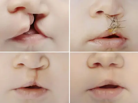 Labbro leporino - cure, denti e percorso di crescita