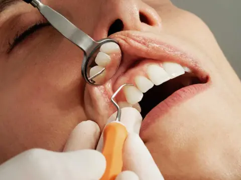 Infezione dentale - Segnali, cure e cosa fare subito
