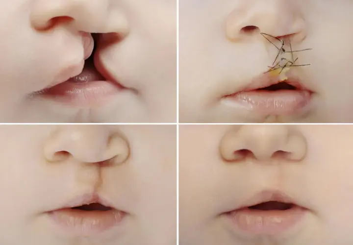 Quattro immagini mostrano l'evoluzione di un labbro leporino: prima, subito dopo l'intervento con suture, e dopo la guarigione.