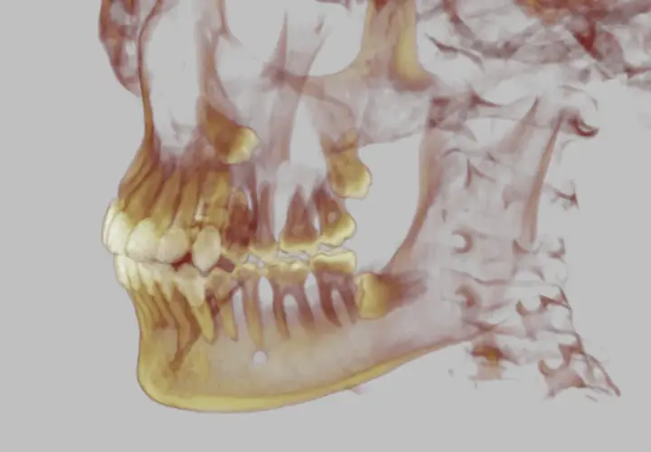 Vista 3D di una mascella con denti, inclusi i molari e un dente del giudizio in fase di eruzione.