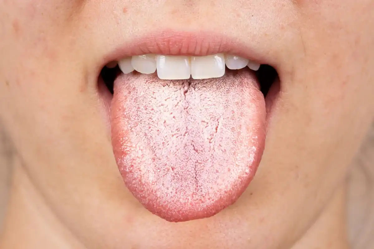 Lingua bianca dopo antibiotici - come riconoscere patina e candidosi