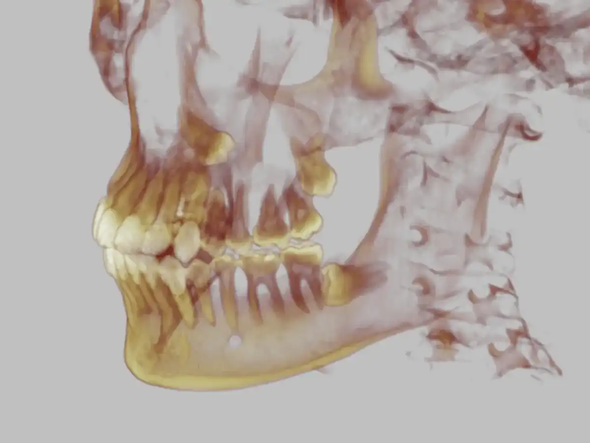 Dente del giudizio, quando estrarlo e come affrontare il recupero