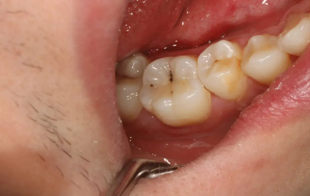 Denti con evidenti segni di carie, macchie scure e ingiallimento.
