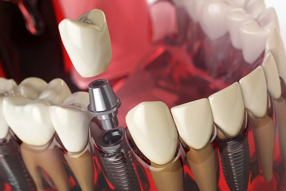 Dettaglio di un impianto dentale con vite e moncone pronti per l'inserimento della corona.