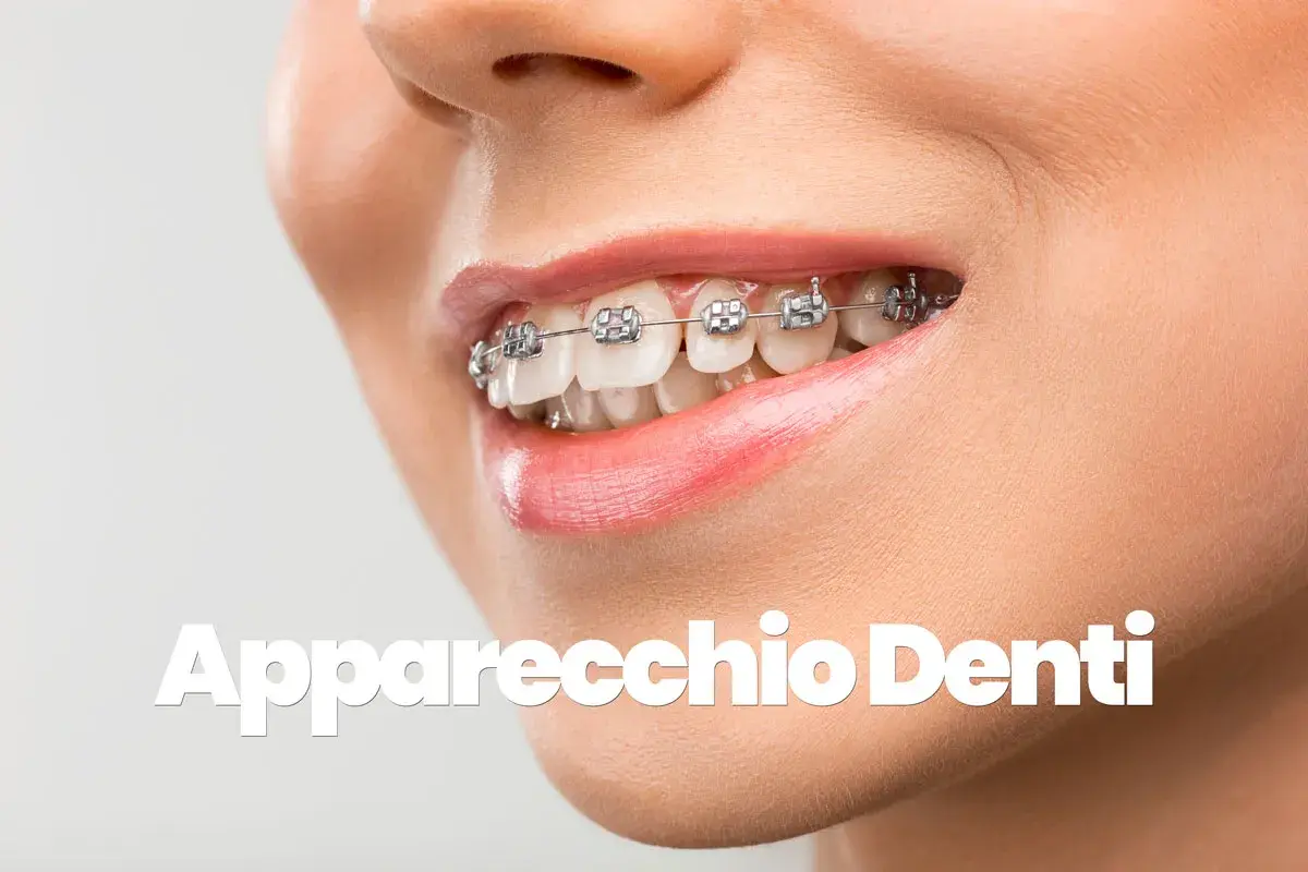 Sorriso con apparecchio denti, per un sorriso perfetto.