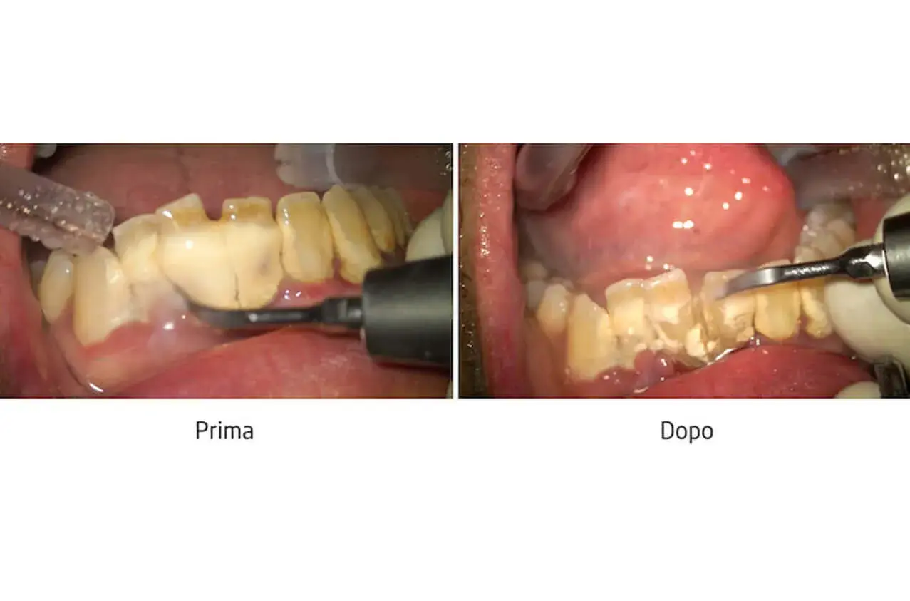Prima e dopo la rimozione del tartaro denti. I denti sono visibilmente più puliti dopo il trattamento.