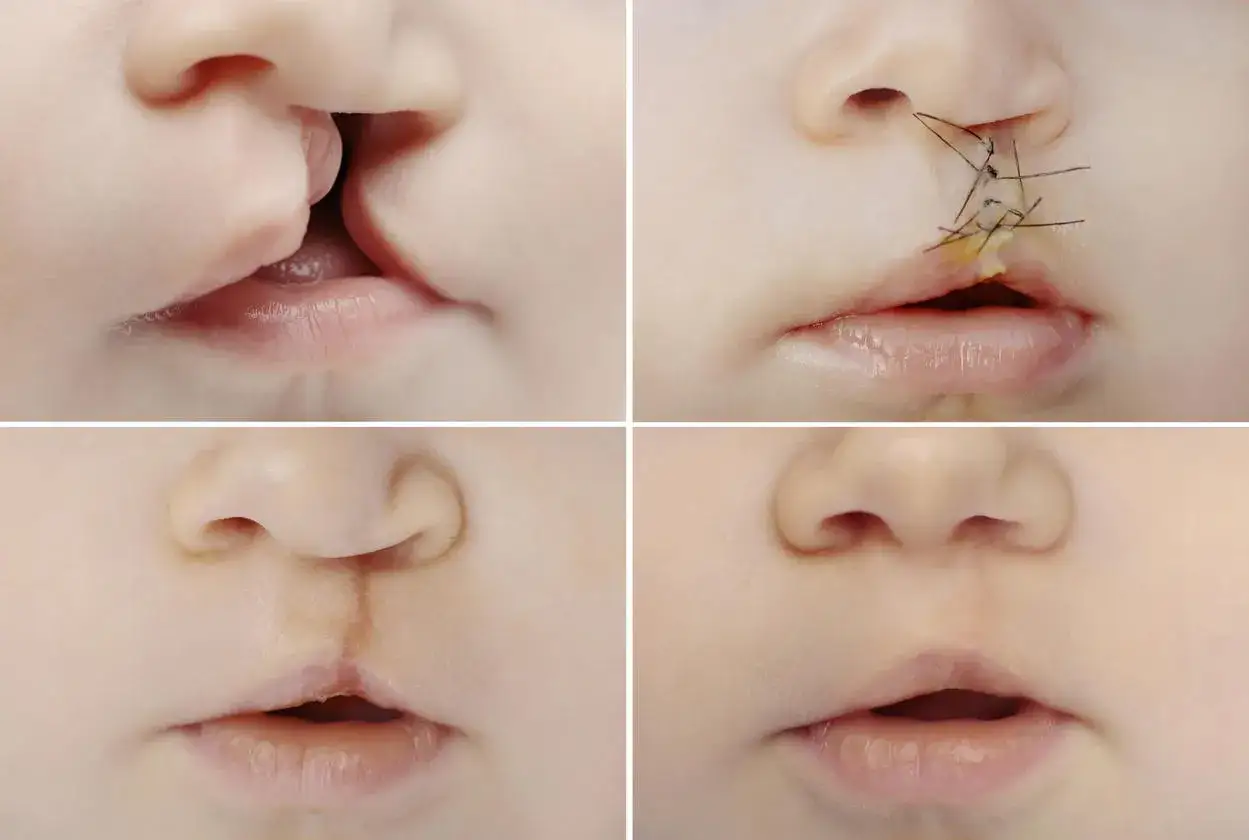Quattro immagini mostrano l'evoluzione di un labbro leporino: prima, subito dopo l'intervento con suture, dopo la rimozione delle suture e infine guarito.