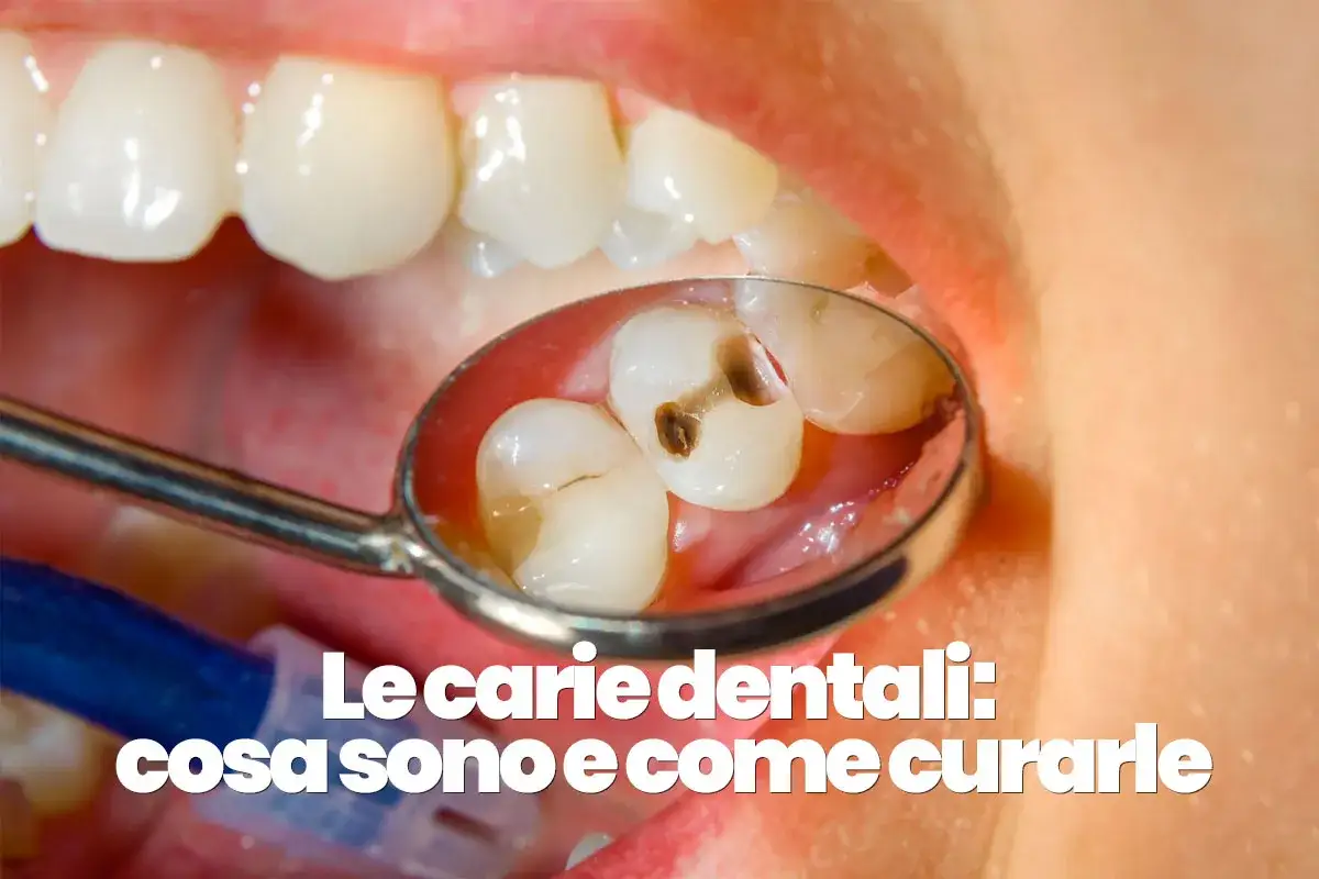 Specchio dentale mostra un dente cariato con una cavità scura. Le carie dentali sono un problema comune da curare.
