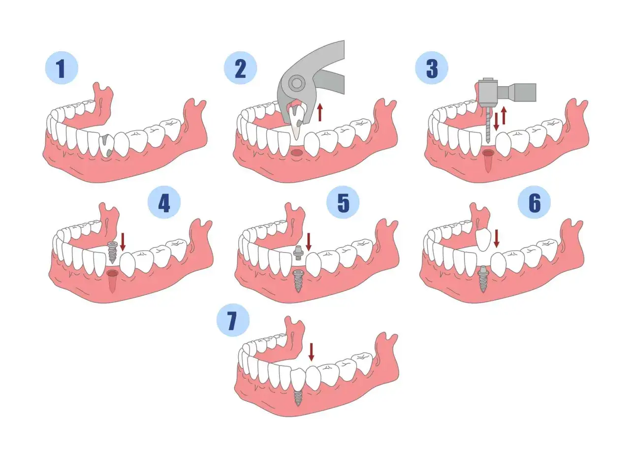Illustrazione delle fasi per un impianto dentale: estrazione, preparazione ossea, inserimento vite, e posizionamento corona.
