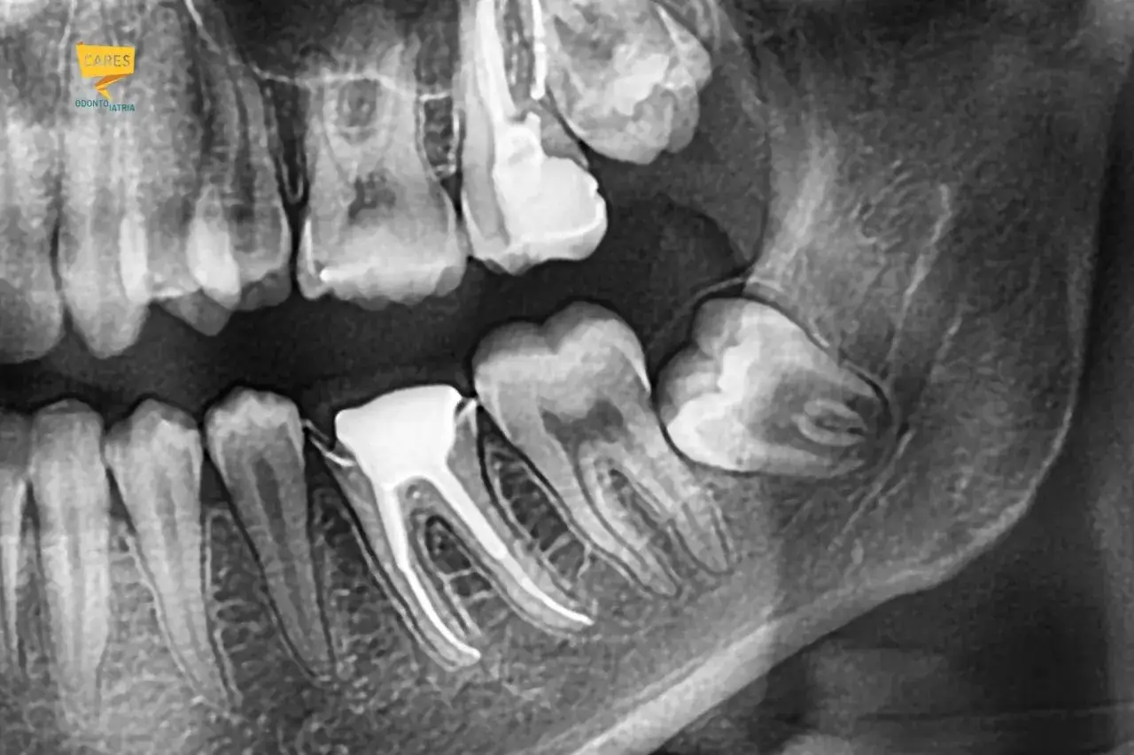 Radiografia dentale mostra un dente del giudizio incluso e altri molari con otturazioni e radici visibili.