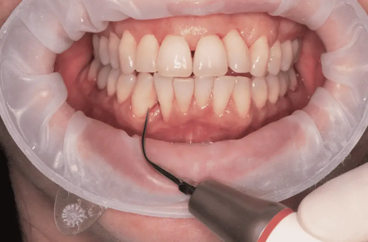 Rimozione del tartaro denti con strumento odontoiatrico.