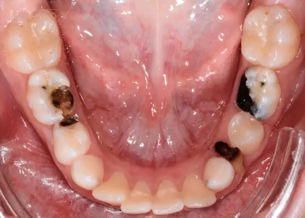 Denti da latte con carie evidenti, alcuni con otturazioni scure.