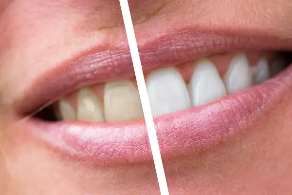 Prima e dopo: denti ingialliti e con placche, poi bianchi e splendenti. Un sorriso trasformato.