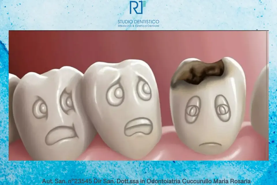Dente cariato - sintomi, cure e quando andare dal dentista